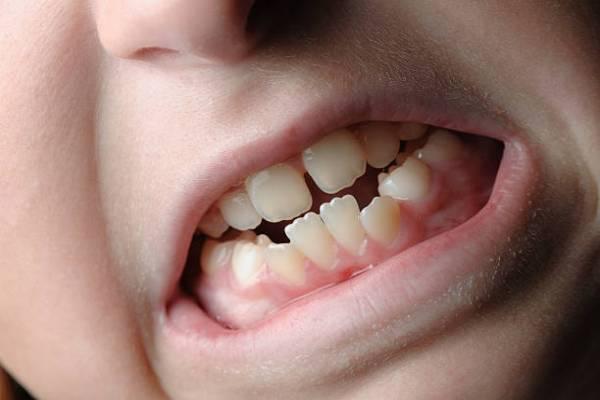 درمان کجی دندان بدون ارتودنسی در خانه