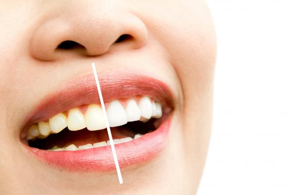 آیا جرم گیری برای دندان مضر است؟